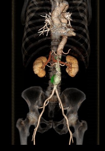 Aorta im CT mit Aneurysma