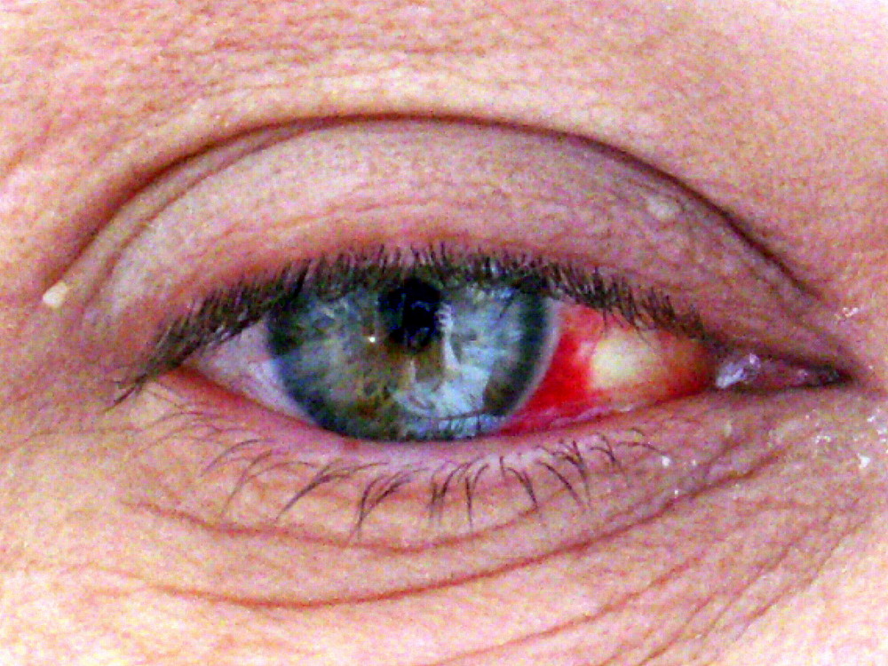 Auge krank