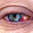 Auge krank