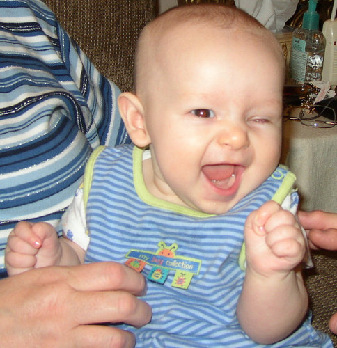 Baby James awaiting eye prosthesis