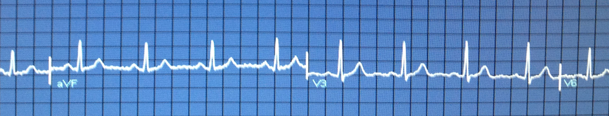 EKG Foto &amp; Bild | 2d-grafik, digitales malen painting, spezial Bilder