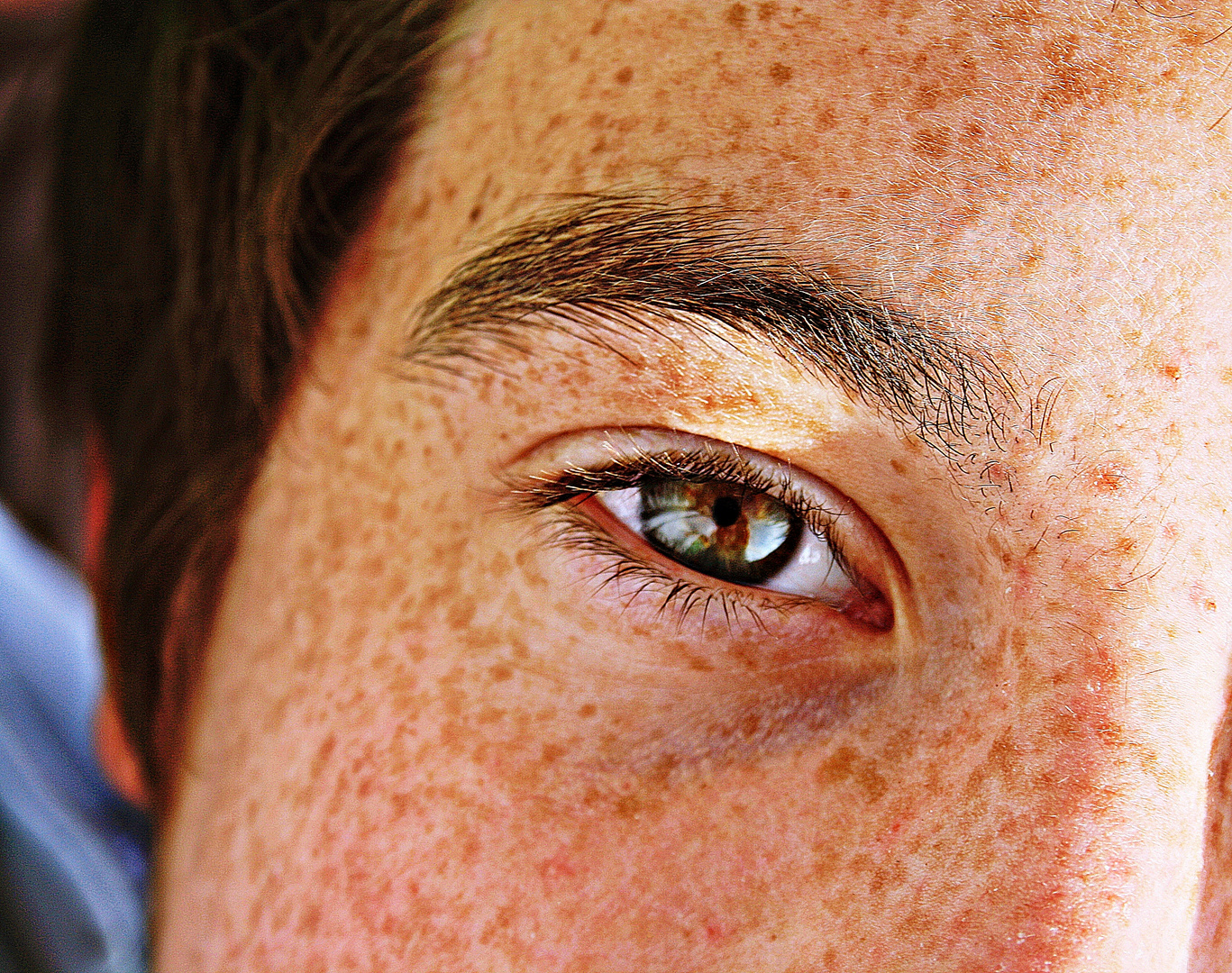 Freckles