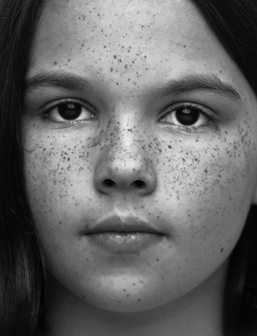 freckles