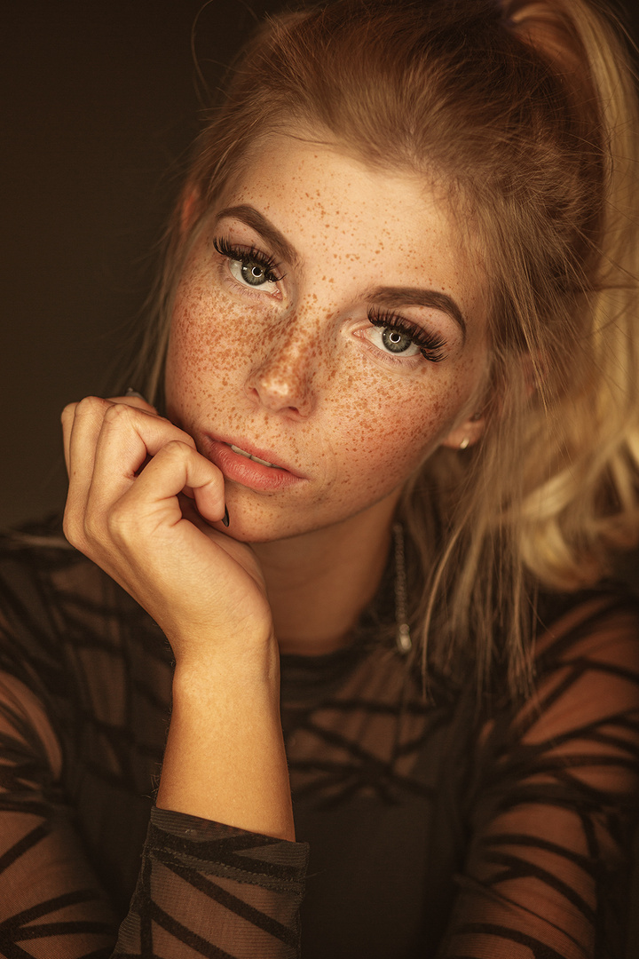 freckles