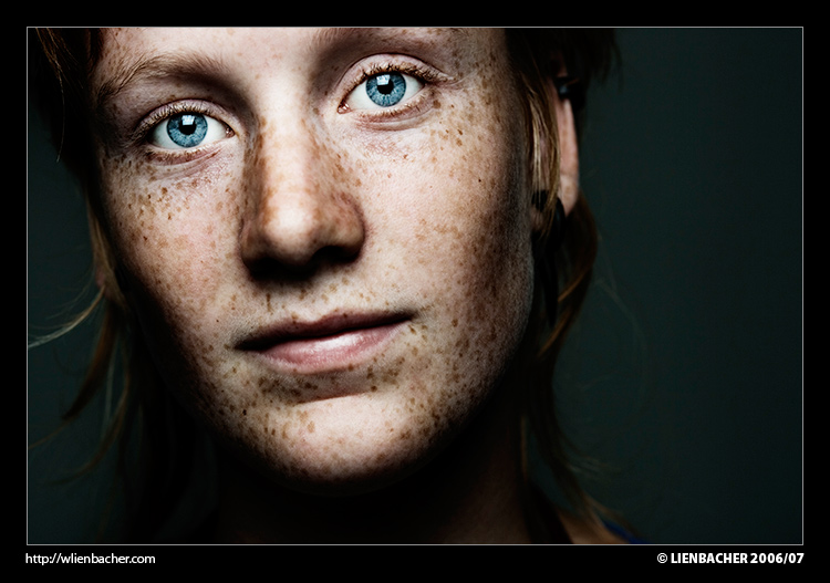 Freckles