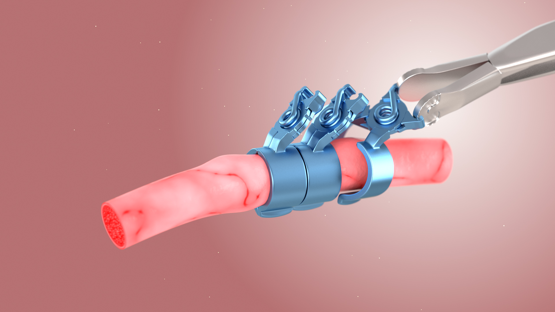 Fusiformes Aneurysma  -  L-Aneurysmen-Clip