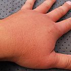 Geschwollene Hand