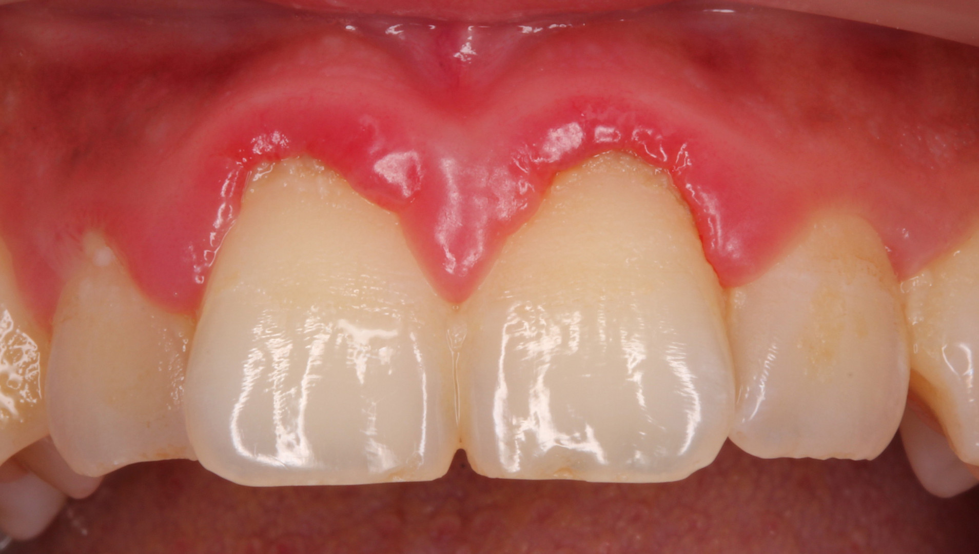 Gingivitis Foto & Bild körperdetails, fleischmann, mund Bilder auf