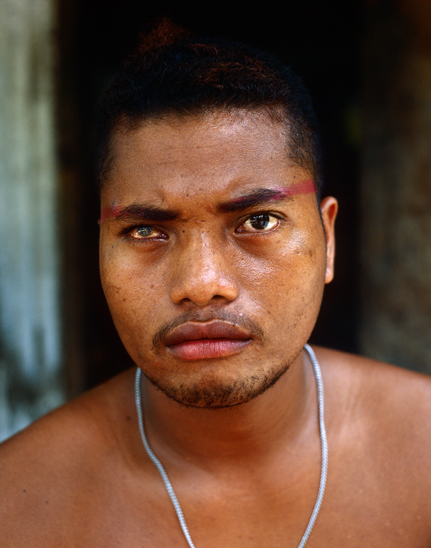 Inselbewohner von Fais mit genetisch bedingtem Defekt am Auge