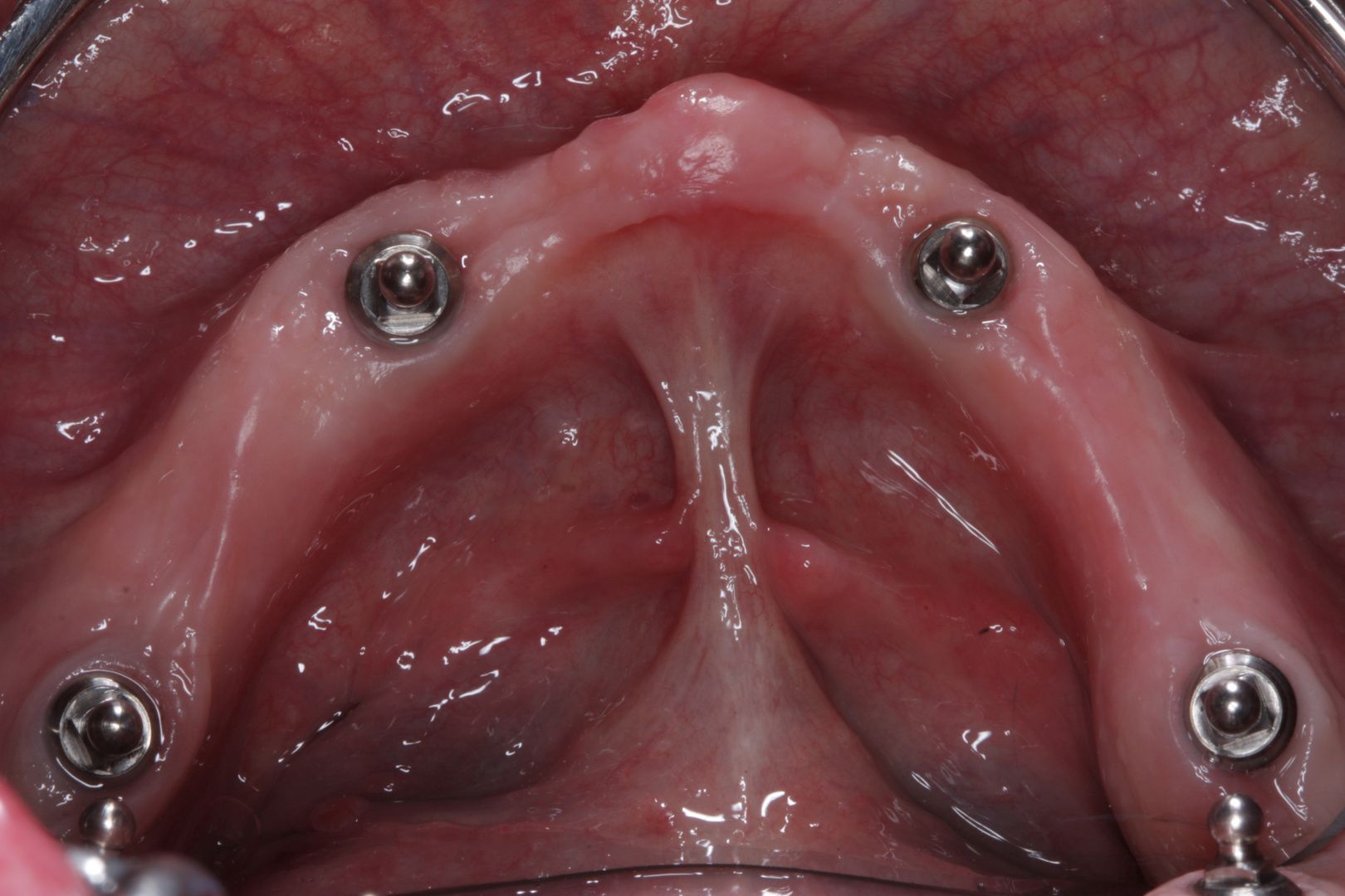 intra-oral: 4 Implantate, Unterkiefer