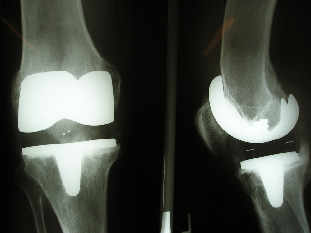 Knie-Totalendoprothese Foto & Bild | industrie und technik, technik ...