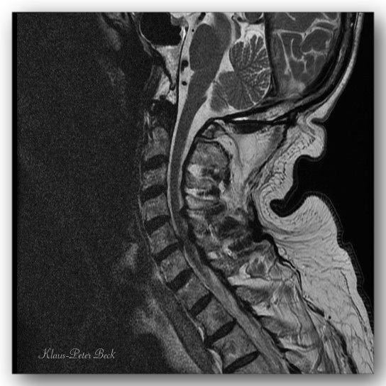 MRT Aufnahme der HWS