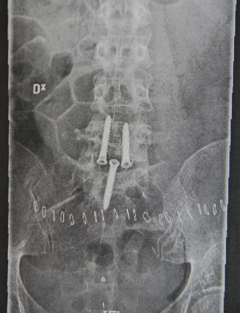 My spineoperation