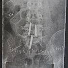 My spineoperation