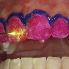 photochemisches Bleaching mit 532nm-Laser