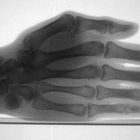 Röntgenaufnahme meiner linken Hand (selfmade)