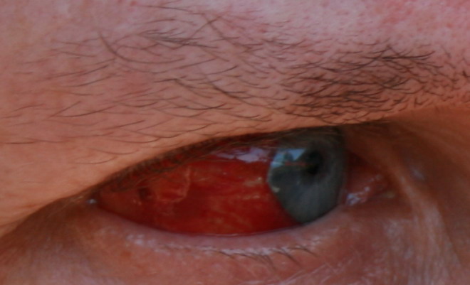 Rotes Auge