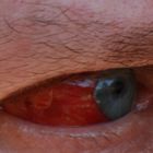 Rotes Auge