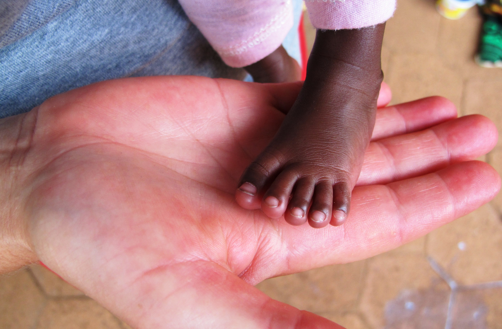 Schweizer Aerzte operieren in Burkina Faso an Noma erkrankte Kinder