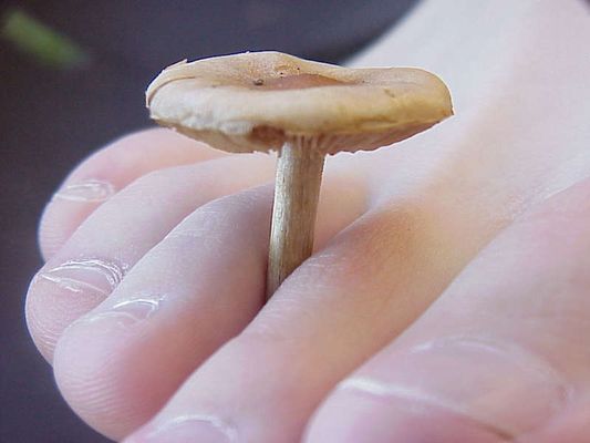 Schwerer Fall von Fußpilz