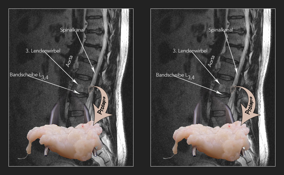 Sequestrierter Nucleus pulposus Prolaps (X)