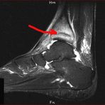 Stressfraktur im distalen Tibia