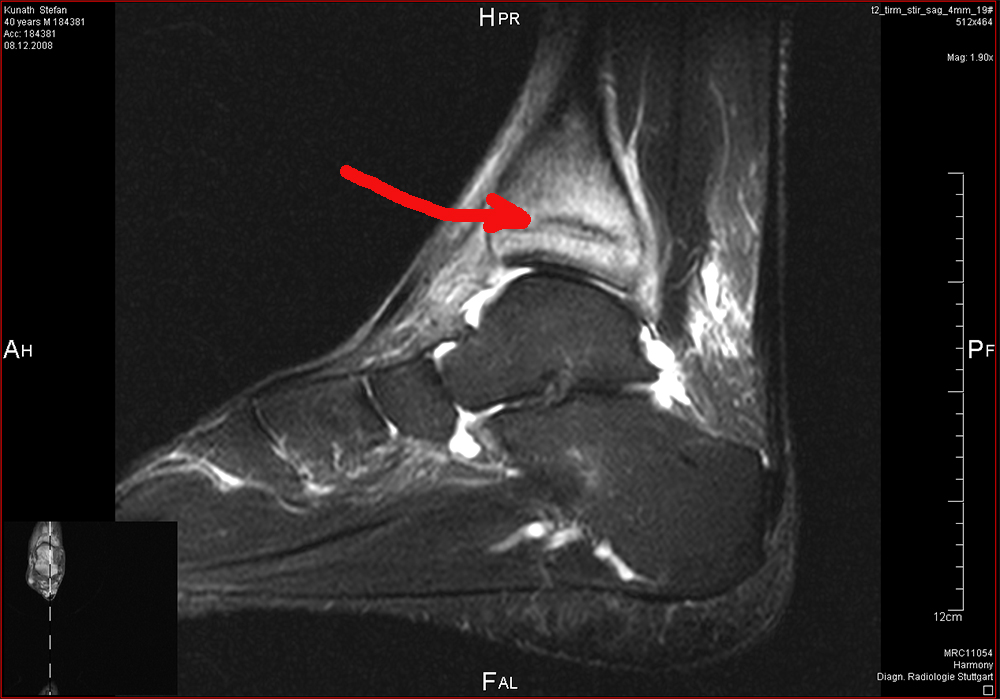 Stressfraktur im distalen Tibia Foto & Bild | alternative u. links Bilder auf fotocommunity
