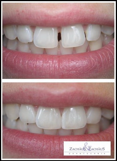 veneers