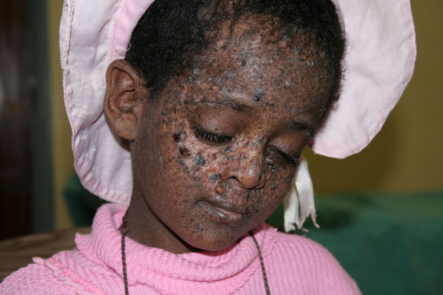 Xeroderma pigmentosa